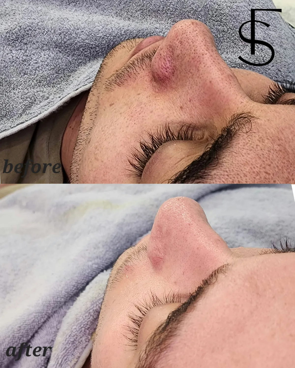 نمونه نتیجه قبل و بعد پاکسازی پوست در فیس استودیوکس شماره 6