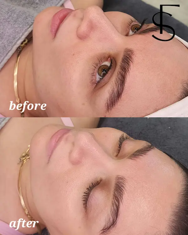 skin-before-after-result0-1.webp