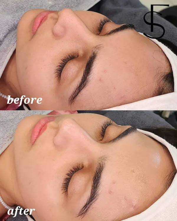 قبل و بعد تنها یک جلسه فیشال تخصصی کنترل چربی